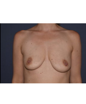 Before Image: Breast Augmentation After Pregnancy Volume Loss - front