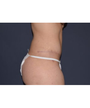 Abdominoplasty with Flank Liposuction