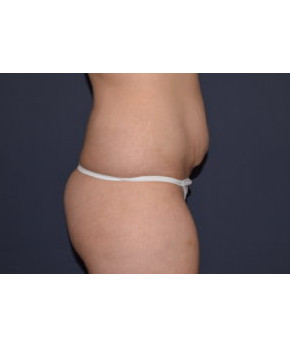 Abdominoplasty with Flank Liposuction