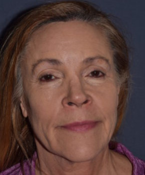 After Image: Facial Rejuvenation – Browlift with Fat Grafting - front