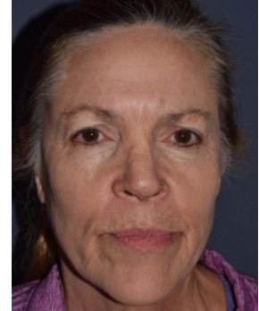 Before Image: Facial Rejuvenation – Browlift with Fat Grafting - front