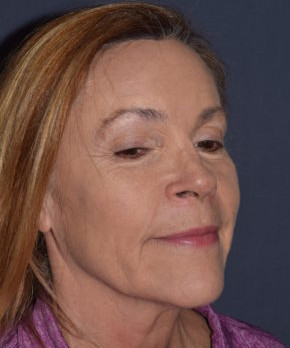 After Image: Facial Rejuvenation – Browlift with Fat Grafting - right-front-oblique