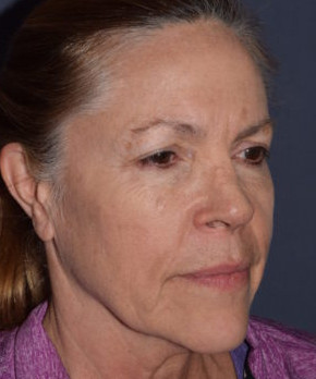 Before Image: Facial Rejuvenation – Browlift with Fat Grafting - right-front-oblique