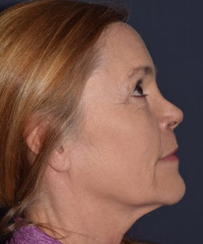 Facial Rejuvenation – Browlift with Fat Grafting