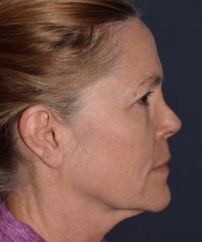 Facial Rejuvenation – Browlift with Fat Grafting