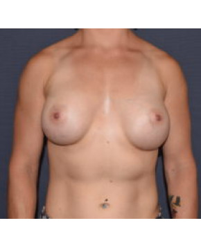 After Image: Breast Augmentation – Body Builder / Fitness - front