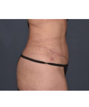 After Image: Abdominoplasty with Flank Liposuction - right-side