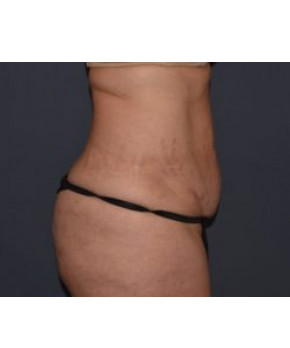 Before Image: Abdominoplasty with Flank Liposuction - right-side