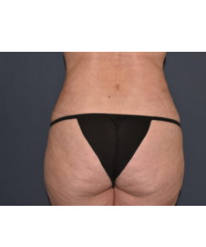 Abdominoplasty with Flank Liposuction