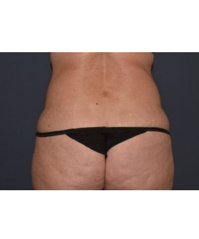Abdominoplasty with Flank Liposuction