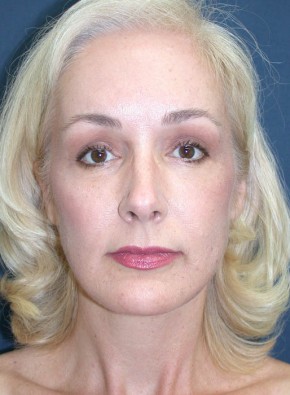 After Image: Facial Rejuvenation – Endoscopic Browlift and Upper Blepharoplasty - front