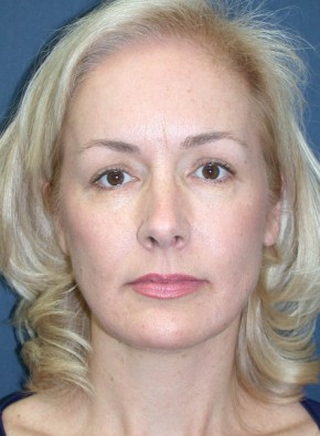 Before Image: Facial Rejuvenation – Endoscopic Browlift and Upper Blepharoplasty - front
