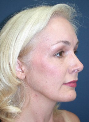 Facial Rejuvenation – Endoscopic Browlift and Upper Blepharoplasty