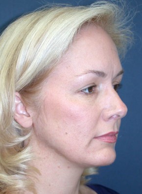 Facial Rejuvenation – Endoscopic Browlift and Upper Blepharoplasty
