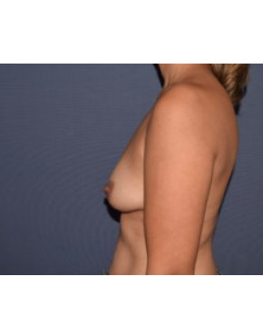Breast Augmentation Ptotic (Sagging) Breasts