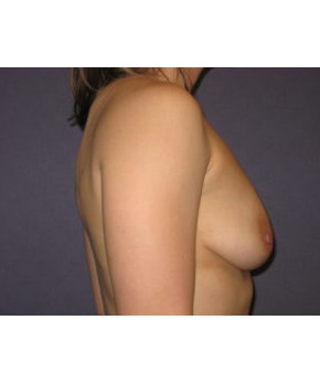 Mommy Makeover 4 – Breast Augmentation Dense Breasts