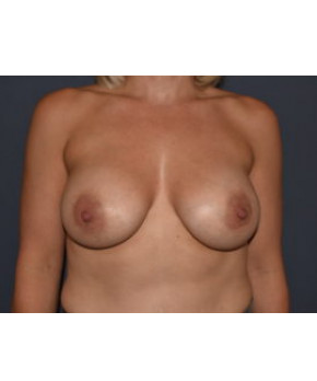 Breast Augmentation – Dense Breasts – 10 Year Result
