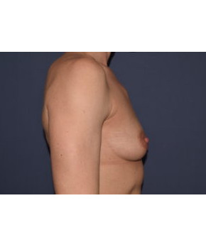 Breast Augmentation After Pregnancy Volume Loss with Asymmetry