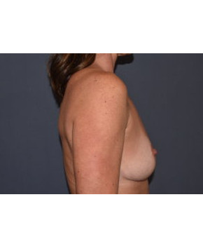 Breast Augmentation Revision with Mesh Support