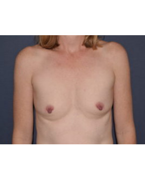 Before Image: Breast Augmentation After Pregnancy Volume Loss - front
