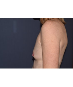 Breast Augmentation After Pregnancy Volume Loss