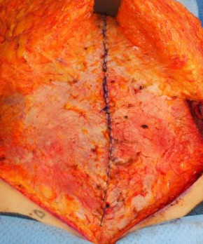 Abdominoplasty with Flank Liposuction and Umbilical Hernia Repair