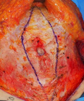 Abdominoplasty with Flank Liposuction and Umbilical Hernia Repair