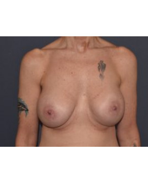 Mastopexy Post Breast Implant Removal
