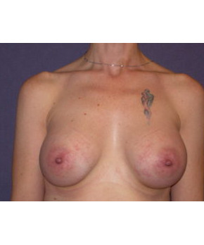 Mastopexy Post Breast Implant Removal