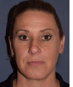 Facial Rejuvenation – Chin Implant