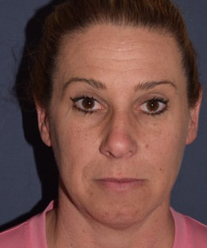 Facial Rejuvenation – Chin Implant