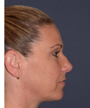 Facial Rejuvenation – Chin Implant