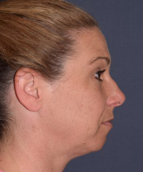 Facial Rejuvenation – Chin Implant