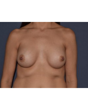 After Image: Breast Augmentation – Dense Breasts - front