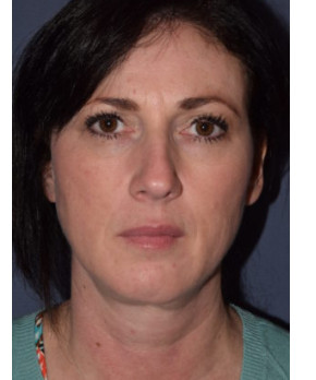 Facial Rejuvenation – Chin Implant