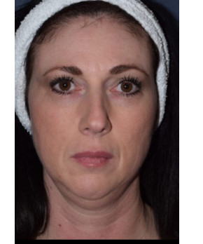 Facial Rejuvenation – Chin Implant
