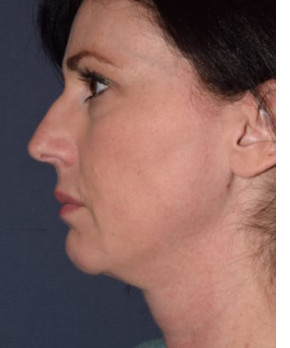 After Image: Facial Rejuvenation – Chin Implant - left-side