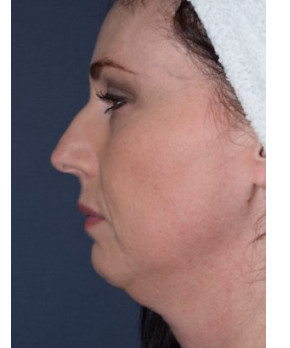 Before Image: Facial Rejuvenation – Chin Implant - left-side