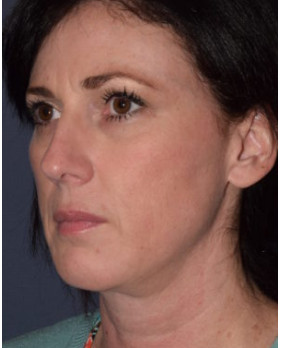 Facial Rejuvenation – Chin Implant