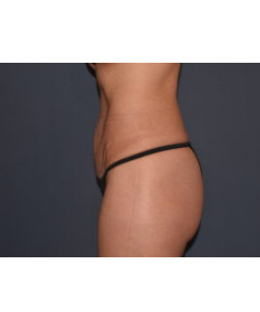 Mommy Makeover 5 – Mini Abdominoplasty with Flank Liposuction