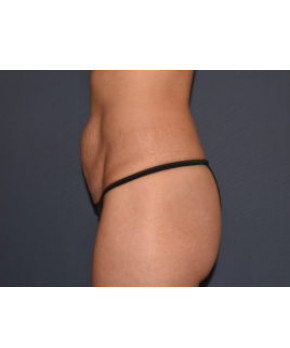 Mommy Makeover 5 – Mini Abdominoplasty with Flank Liposuction