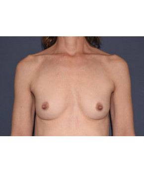 Before Image: Breast Augmentation After Pregnancy Volume Loss - front