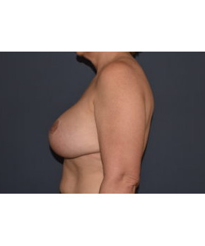 Breast Augmentation Revision – Capsulectomy with Implant Exchange