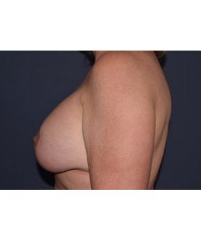 Breast Augmentation Revision – Capsulectomy with Implant Exchange