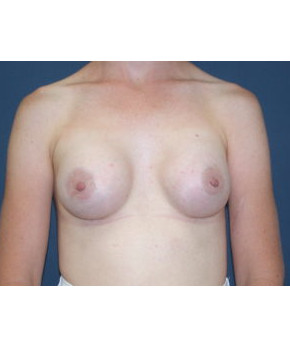 After Image: Breast Augmentation After Pregnancy Volume Loss – 17 Year Result - front