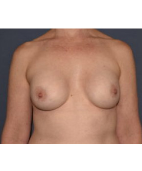 Breast Augmentation After Pregnancy Volume Loss – 17 Year Result
