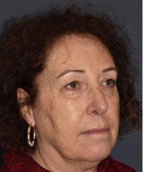 Rhinoplasty – Open with Functional Airway