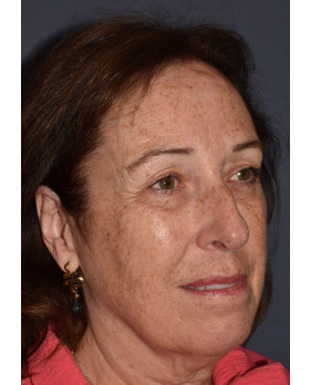 Rhinoplasty – Open with Functional Airway