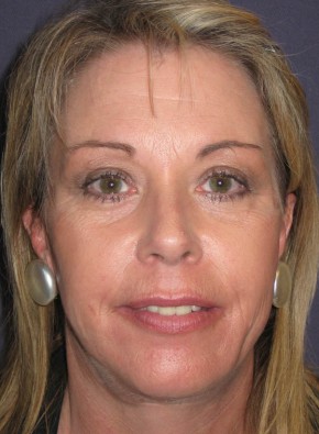 After Image: Facial Rejuvenation – Facelift, Browlift, and Chin Implant