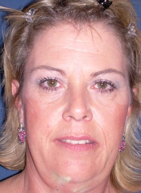 Before Image: Facial Rejuvenation – Facelift, Browlift, and Chin Implant